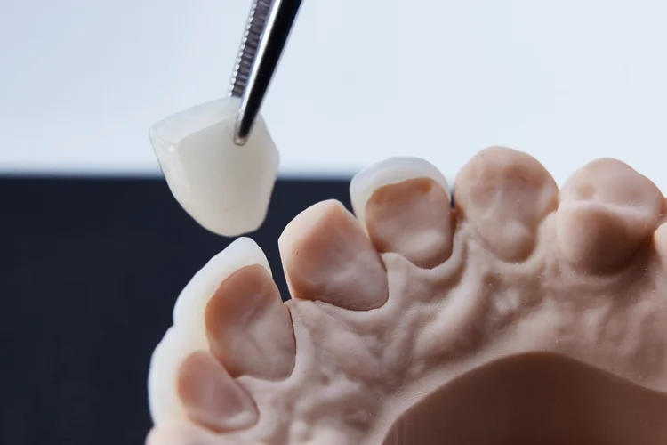 Zirconia dental crown being placed on a prepared tooth model to illustrate dental crown procedure.